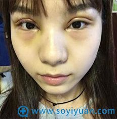 <!--<i data=20240710 data-id=9309></i>-->眼综合案例 <!--<i data=20240710 data-id=9309></i>-->眼综合案例