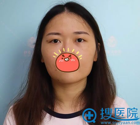 在芜湖伊莱美割双眼皮前 在芜湖伊莱美割双眼皮前