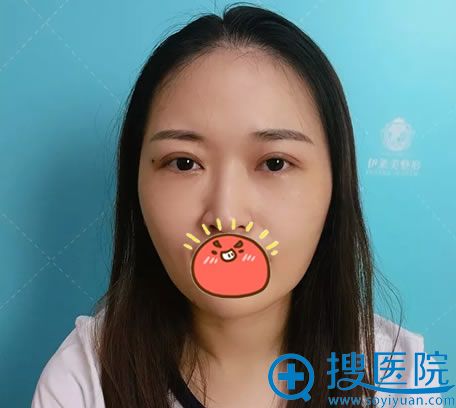 芜湖伊莱美郭国臣割双眼皮15天效果 芜湖伊莱美郭国臣割双眼皮15天效果