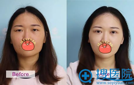 芜湖伊莱美郭国臣双眼皮案例对比图 芜湖伊莱美郭国臣双眼皮案例对比图