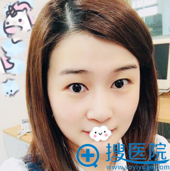 合肥华美朱德刚双眼皮+开眼角真人案例 合肥华美朱德刚双眼皮+开眼角真人案例