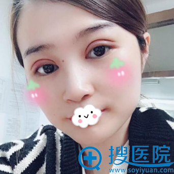 合肥华美双眼皮怎么样?朱德刚眼部整形案例 合肥华美双眼皮怎么样?朱德刚眼部整形案例