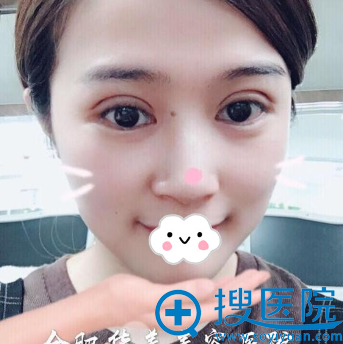 合肥华美朱德刚全切双眼皮+开眼角术后效果 合肥华美朱德刚全切双眼皮+开眼角术后效果