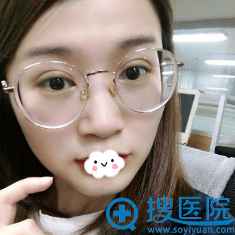 合肥华美朱德刚精切双眼皮半月效果图 合肥华美朱德刚精切双眼皮半月效果图