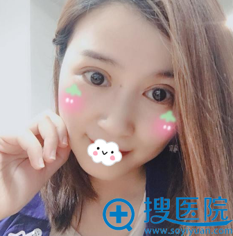 合肥华美朱德刚精切双眼皮1月案例照片 合肥华美朱德刚精切双眼皮1月案例照片