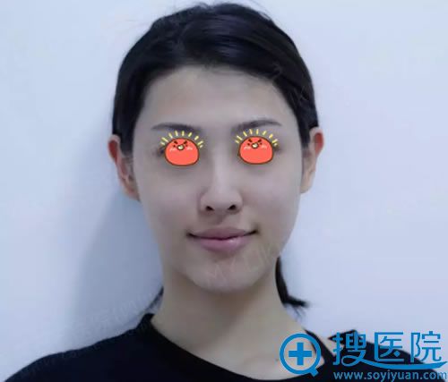 看到成都美莱推出长效脂肪胶,于是找熊猛做了自体脂肪填充面部