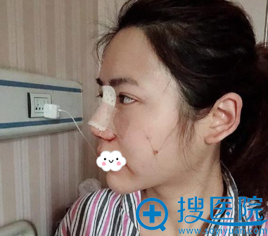 成都医美刘国权鼻子做的怎么样?假体隆鼻综合整形效果 成都医美刘国权鼻子做的怎么样?假体隆鼻综合整形效果