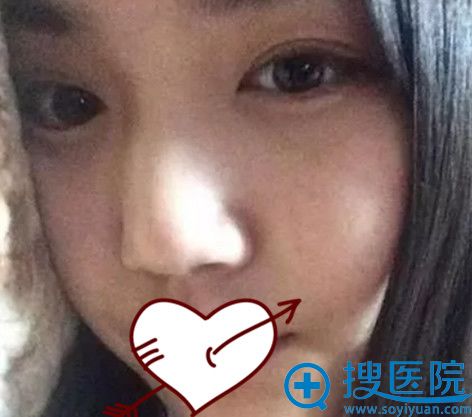 我的驼峰鼻是在阜阳东方美莱坞整形矫正的 术后上镜貌似网红