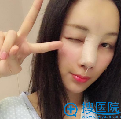 杭州甄美整形医院王辉医生隆鼻术后两天 杭州甄美整形医院王辉医生隆鼻术后两天
