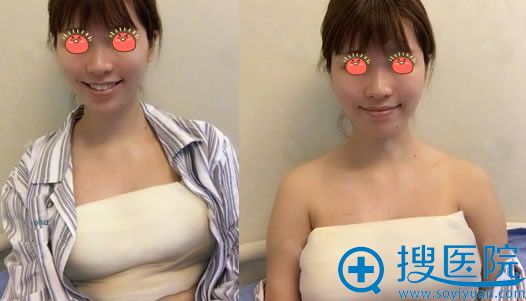 在重庆爱思特做隆胸7天后 在重庆爱思特做隆胸7天后