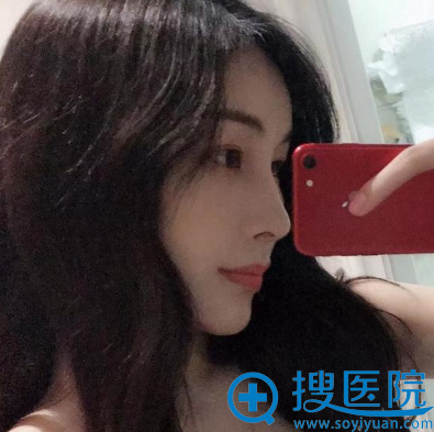 咋杭州甄美做完鼻子12天效果 咋杭州甄美做完鼻子12天效果