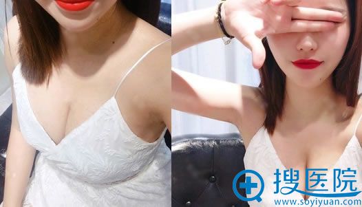 做完大腿抽脂和自体脂肪隆胸15天后 做完大腿抽脂和自体脂肪隆胸15天后