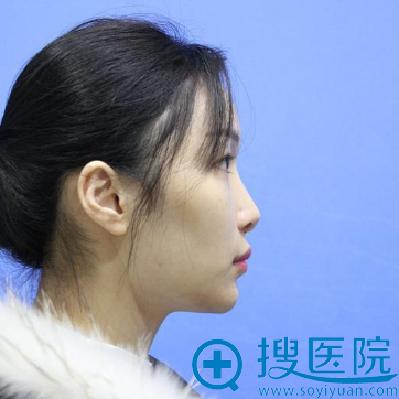 分享我找杭州甄美整形医院王辉做肋软骨鼻综合隆鼻的手术经历