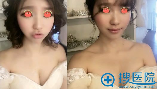 重庆爱思特做脂肪丰胸35天效果 重庆爱思特做脂肪丰胸35天效果