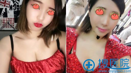 重庆爱思特刘中林隆胸案例4个月效果 重庆爱思特刘中林隆胸案例4个月效果