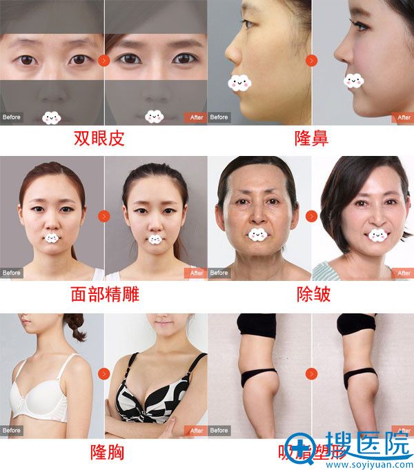 张家港唯恩双眼皮隆鼻隆胸真人案例 张家港唯恩双眼皮隆鼻隆胸真人案例