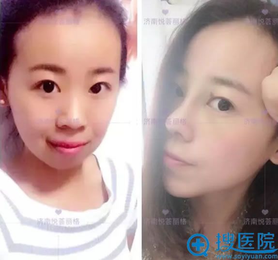 员工分享济南悦荟丽格刘顺做双眼皮+肋软骨隆鼻+垫下巴过程图