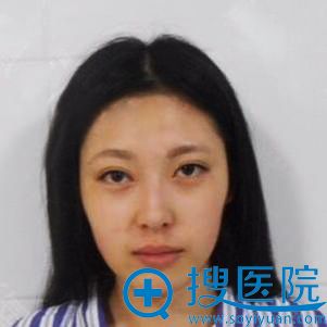 朋友推荐我找沈阳盛京尚美“刀叔”王超做了纳米脂肪填充全脸