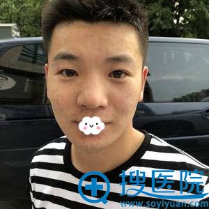 俊男分享在杭州维多利亚马腾处做切开双眼皮15天效果图
