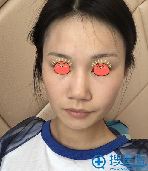 艺考挫败让我痛下决心找邵阳温州小张整形万群武做了膨体隆鼻