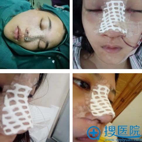 <!--<i data=20240710 data-id=15881></i>-->做隆鼻手术过程 <!--<i data=20240710 data-id=15881></i>-->做隆鼻手术过程