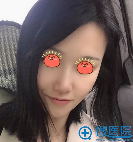做完膨体隆鼻手术30天恢复照 做完膨体隆鼻手术30天恢复照