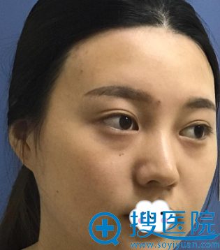 怕玻尿酸时间短取肋骨疼让杭州艾菲(原恒颜) 赵德星做假体隆鼻