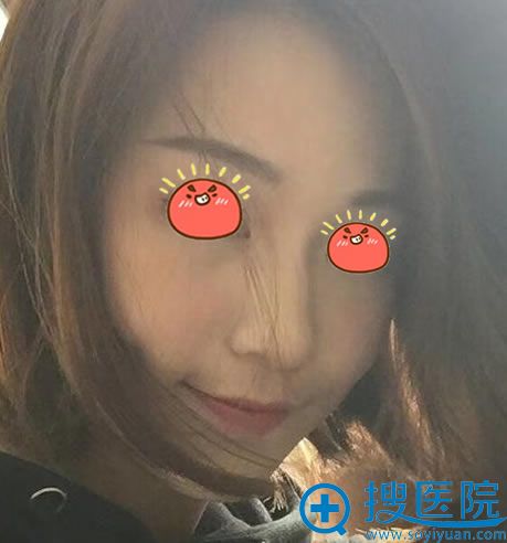 <!--<i data=20240710 data-id=15881></i>-->做隆鼻2个月效果 <!--<i data=20240710 data-id=15881></i>-->做隆鼻2个月效果