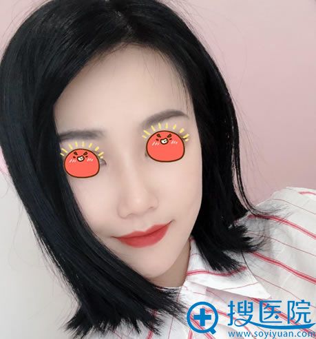 做完膨体隆鼻3个月恢复效果图 做完膨体隆鼻3个月恢复效果图