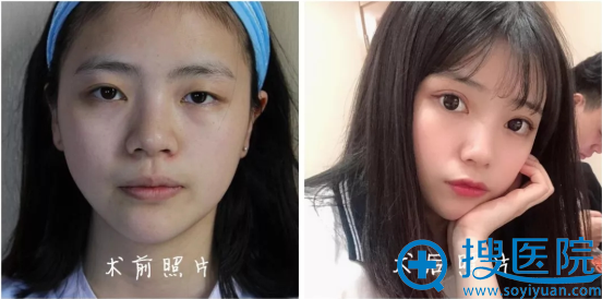 <!--<i data=20240710 data-id=12771></i>-->医疗美容整形医院双眼皮案例 <!--<i data=20240710 data-id=12771></i>-->医疗美容整形医院双眼皮案例