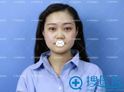 原来线雕面部提升真的可以快速年轻,不信看江苏施尔美效果对比