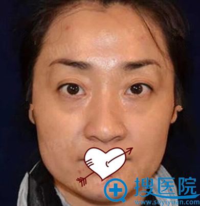 让沈阳金皇后宁雪玉做全脸线雕20天啦,晒图来验证效果好吗
