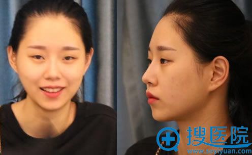 找南宁爱思特孙晓捷做双眼皮前 找南宁爱思特孙晓捷做双眼皮前