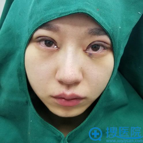 刚做完双眼皮和开眼角的图片 刚做完双眼皮和开眼角的图片