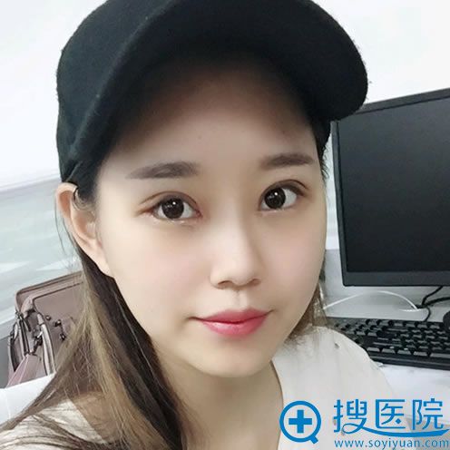 在广西爱思特做双眼皮7天效果 在广西爱思特做双眼皮7天效果
