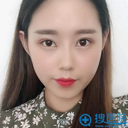南宁爱思特双眼皮案例20天效果 南宁爱思特双眼皮案例20天效果