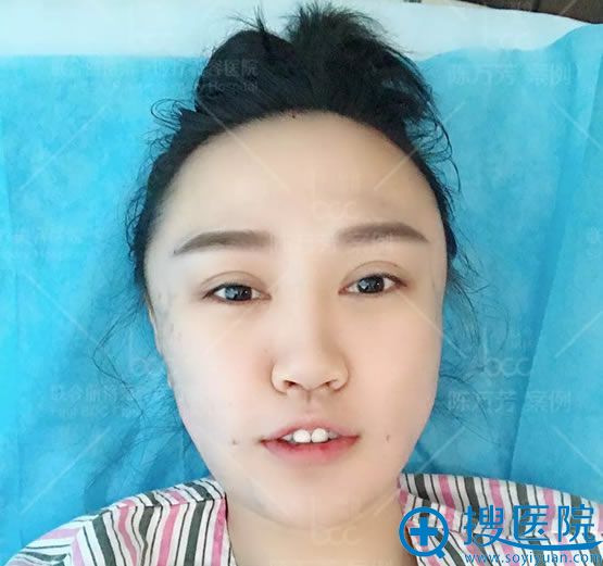 做完自体脂肪填充4小时后照片 做完自体脂肪填充4小时后照片
