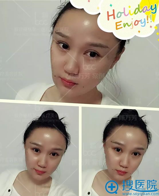 北京联合丽格做脂肪填充8小时效果 北京联合丽格做脂肪填充8小时效果