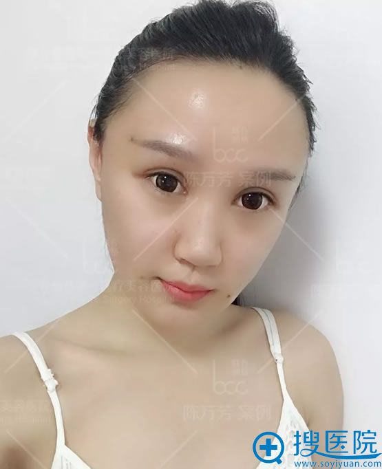 北京联合丽格陈万芳脂肪填充24小时效果 北京联合丽格陈万芳脂肪填充24小时效果