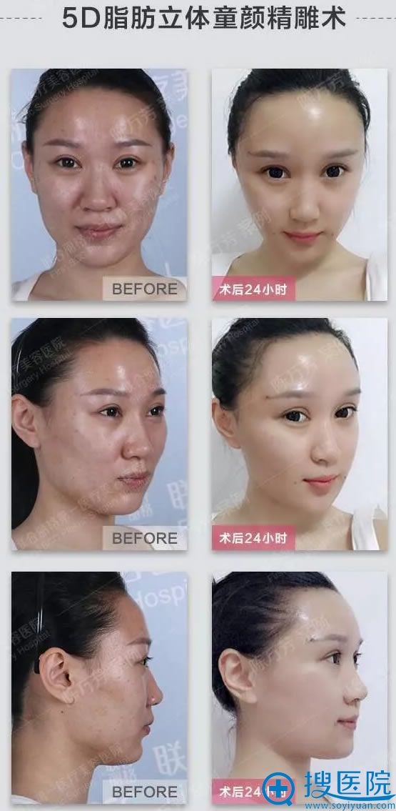 北京联合丽格陈万芳脂肪填充案例对比图 北京联合丽格陈万芳脂肪填充案例对比图