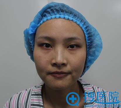 在南通俪人和维多利亚之间我选择俪人朱如岗院长做双眼皮开眼角
