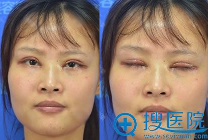 选择南通俪人朱云岗做双眼皮即刻效果 选择南通俪人朱云岗做双眼皮即刻效果