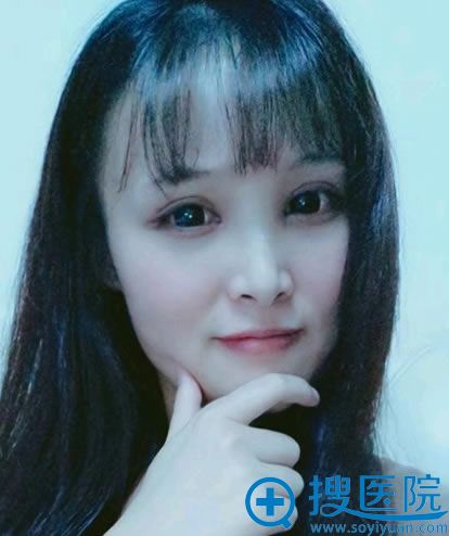 做完双眼皮和开眼角4天恢复照 做完双眼皮和开眼角4天恢复照
