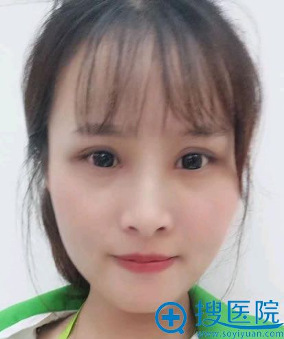 南通俪人朱云岗双眼皮案例10天效果 南通俪人朱云岗双眼皮案例10天效果