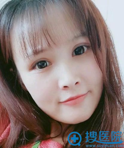 选择南通俪人割双眼皮1个月照片 选择南通俪人割双眼皮1个月照片