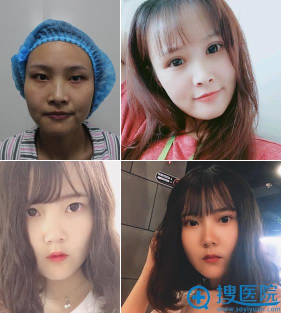 南通俪人整形双眼皮和隆鼻案例 南通俪人整形双眼皮和隆鼻案例