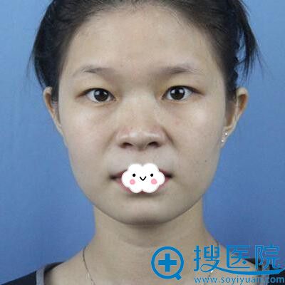 在深圳雅涵割双眼皮+自体脂肪丰面+鼻中隔软骨隆鼻堪比换脸