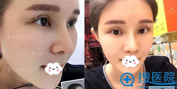 深圳雅涵高山双眼皮+隆鼻+自体脂肪丰面术后1月效果 深圳雅涵高山双眼皮+隆鼻+自体脂肪丰面术后1月效果