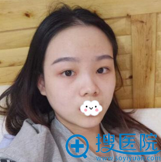 若不是让重庆瑞俪李光强做假体隆鼻/鼻尖塑形哪知道效果这样好