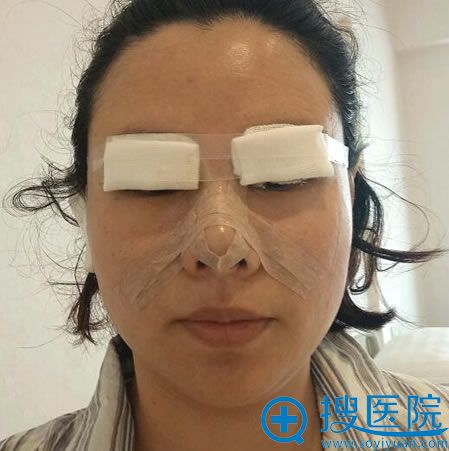 刚做完双眼皮和隆鼻的图片 刚做完双眼皮和隆鼻的图片
